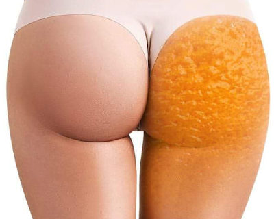 Cellulite-Therapie